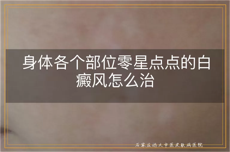身体各个部位零星点点的白癜风怎么治
