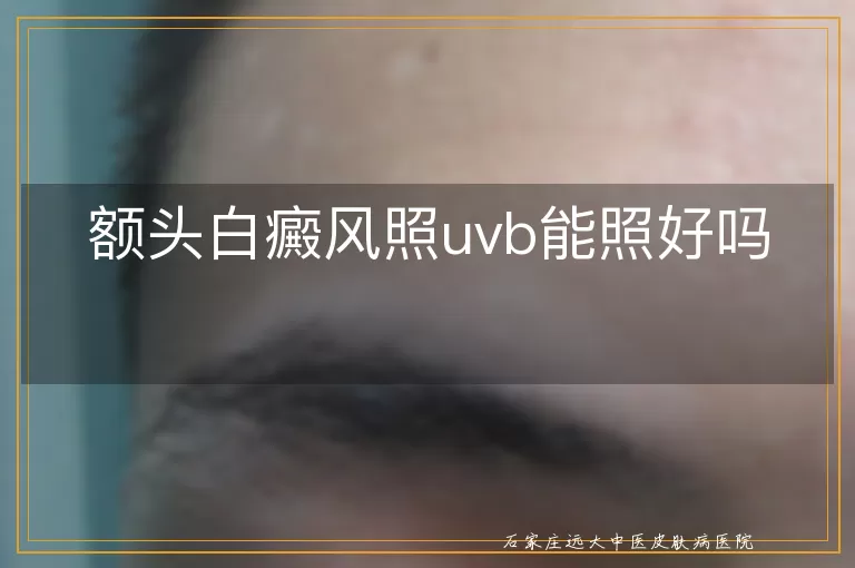 额头白癜风照uvb能照好吗
