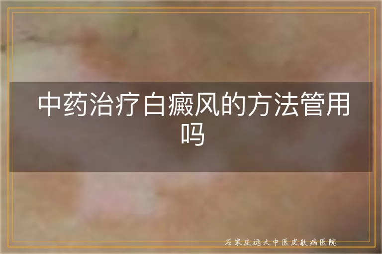 中药治疗白癜风的方法管用吗