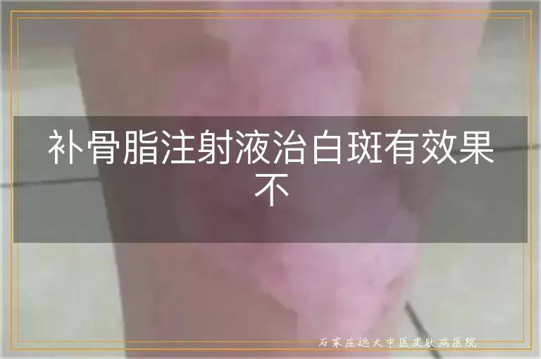 补骨脂注射液治白斑有效果不