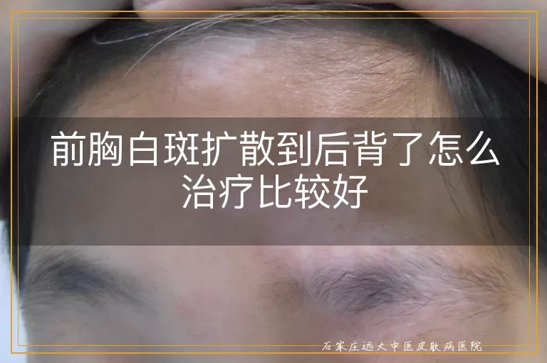 前胸白斑扩散到后背了怎么治疗比较好