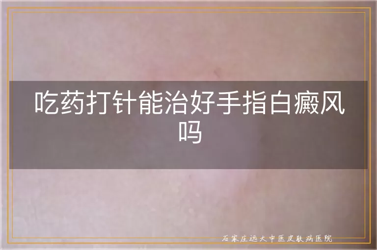 吃药打针能治好手指白癜风吗