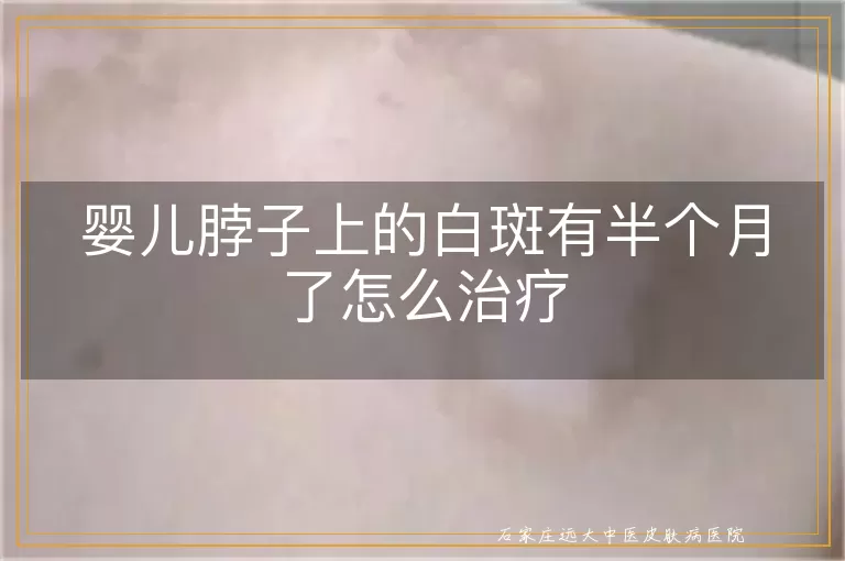 婴儿脖子上的白斑有半个月了怎么治疗