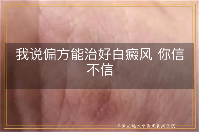我说偏方能治好白癜风 你信不信