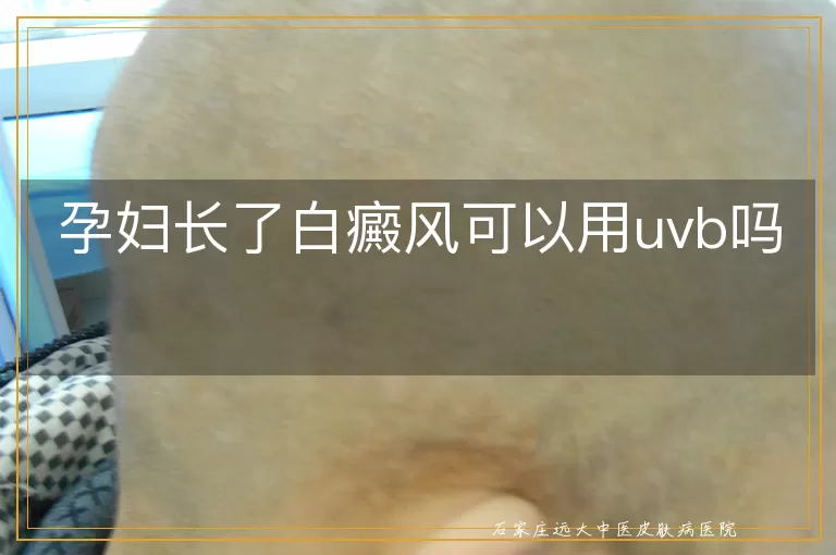 孕妇长了白癜风可以用uvb吗