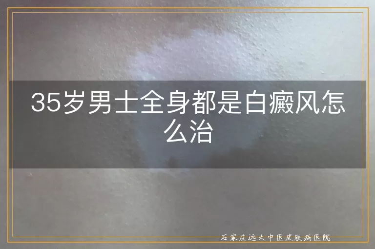 35岁男士全身都是白癜风怎么治