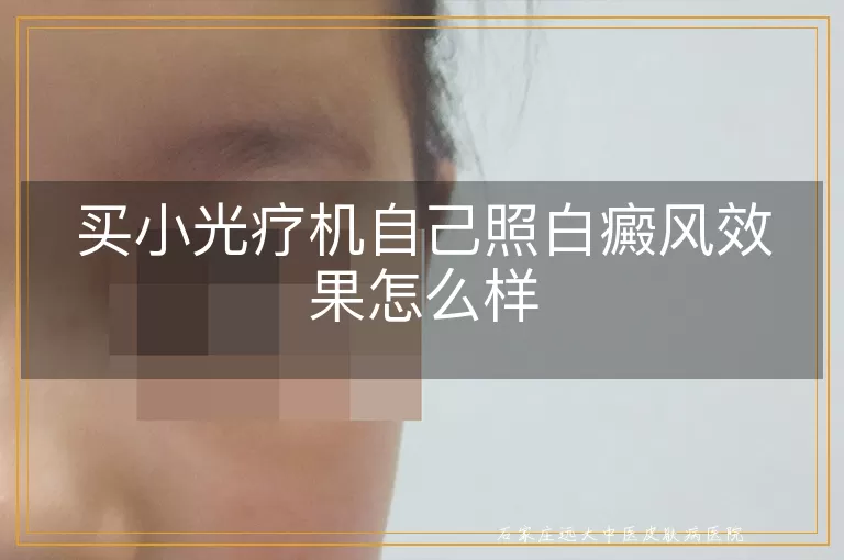 买小光疗机自己照白癜风效果怎么样