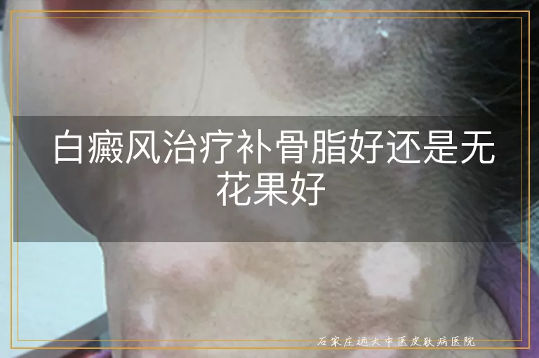 白癜风治疗补骨脂好还是无花果好