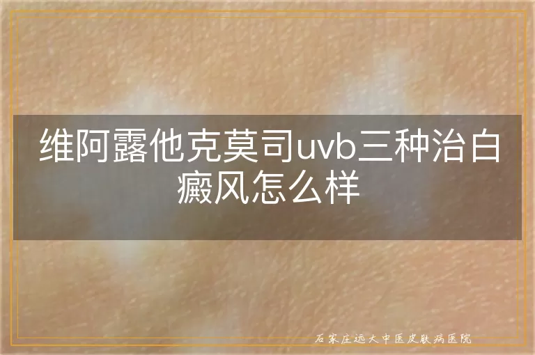 维阿露他克莫司uvb三种治白癜风怎么样