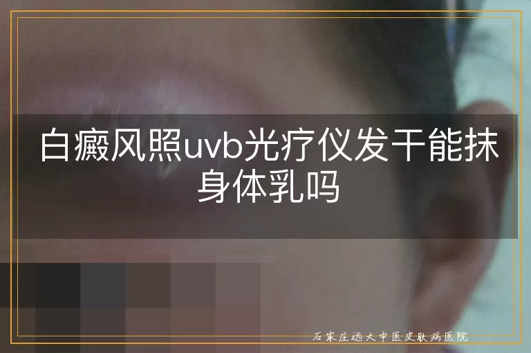 白癜风照uvb光疗仪发干能抹身体乳吗