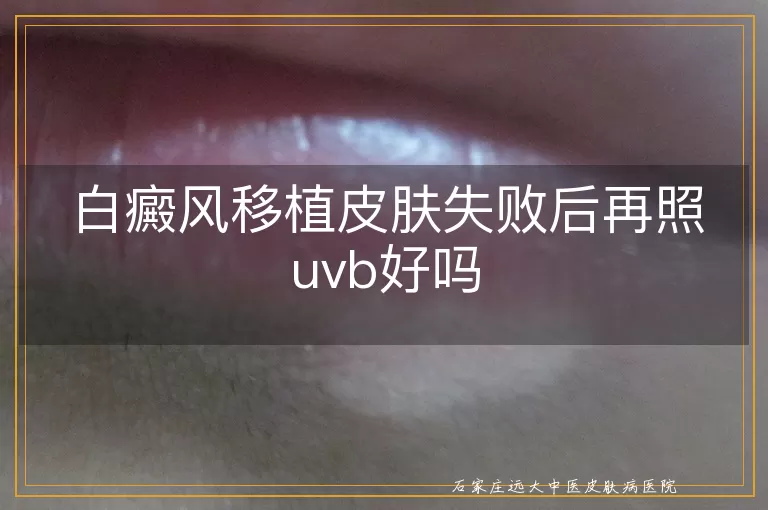 白癜风移植皮肤失败后再照uvb好吗