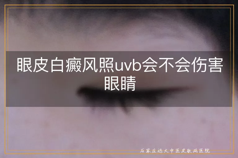 眼皮白癜风照uvb会不会伤害眼睛