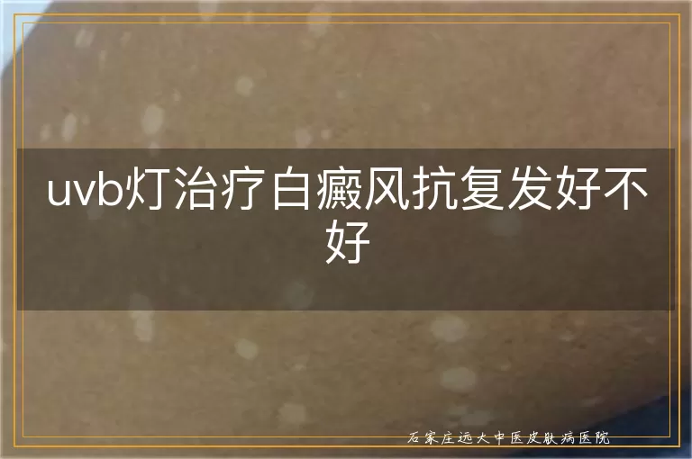 uvb灯治疗白癜风抗复发好不好