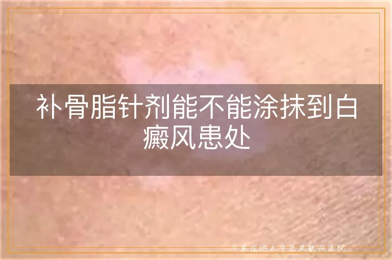 补骨脂针剂能不能涂抹到白癜风患处
