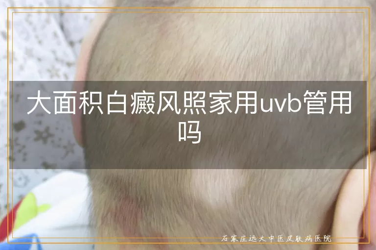 大面积白癜风照家用uvb管用吗