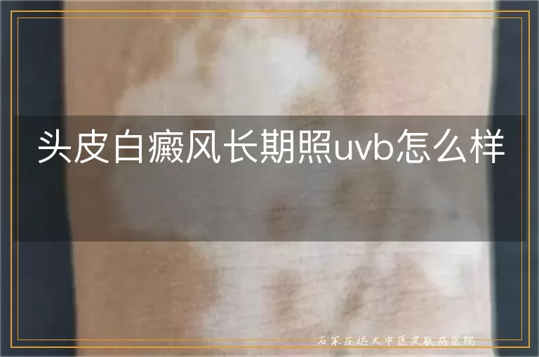 头皮白癜风长期照uvb怎么样