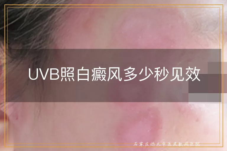 UVB照白癜风多少秒见效