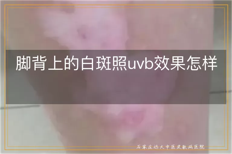 脚背上的白斑照uvb效果怎样
