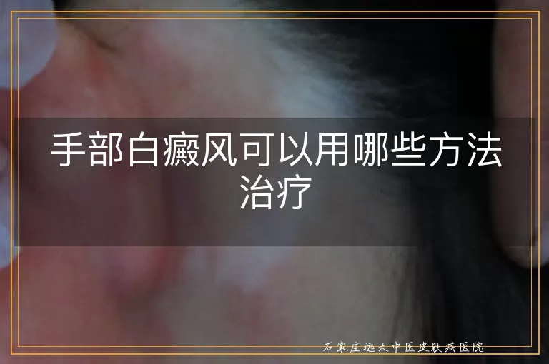 手部白癜风可以用哪些方法治疗
