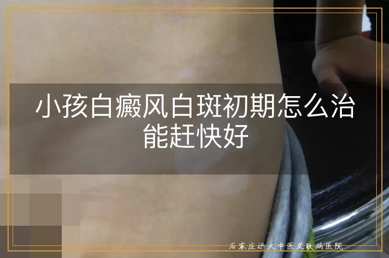 小孩白癜风白斑初期怎么治能赶快好