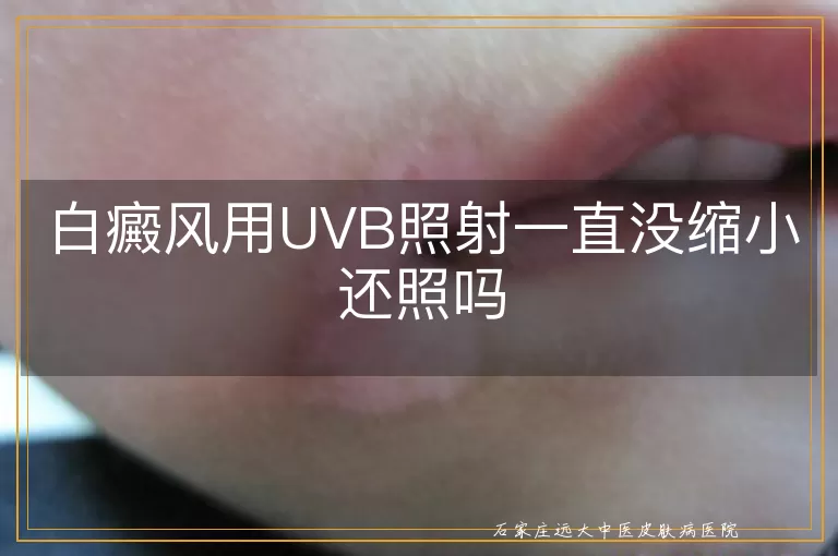 白癜风用UVB照射一直没缩小还照吗