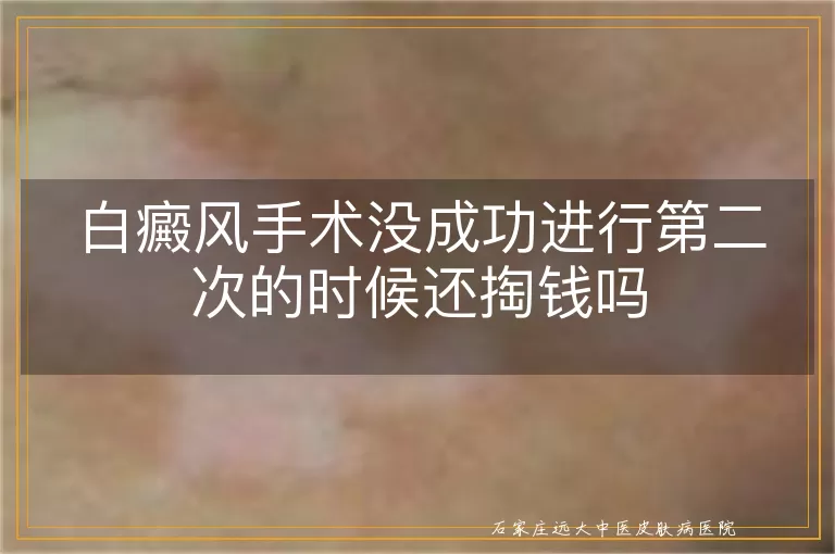 白癜风手术没成功进行第二次的时候还掏钱吗