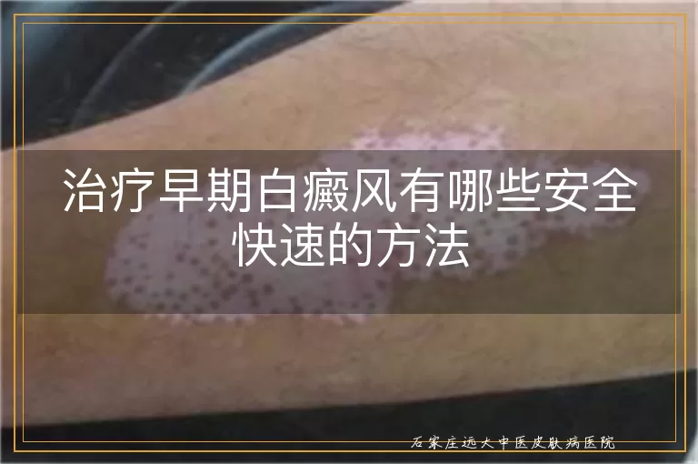 治疗早期白癜风有哪些安全快速的方法