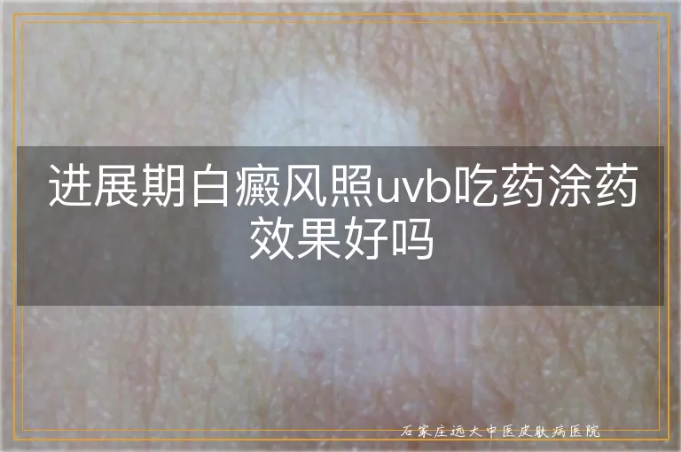 进展期白癜风照uvb吃药涂药效果好吗