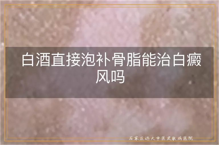 白酒直接泡补骨脂能治白癜风吗