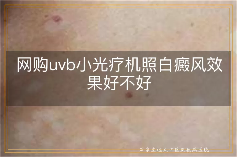 网购uvb小光疗机照白癜风效果好不好