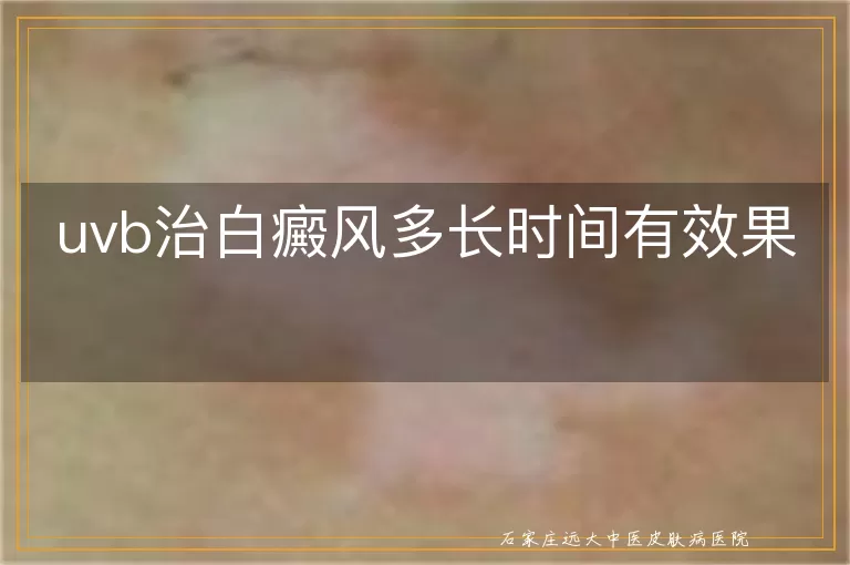 uvb治白癜风多长时间有效果
