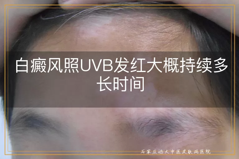 白癜风照UVB发红大概持续多长时间