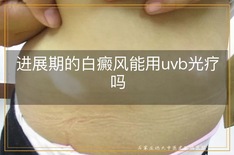 进展期的白癜风能用uvb光疗吗