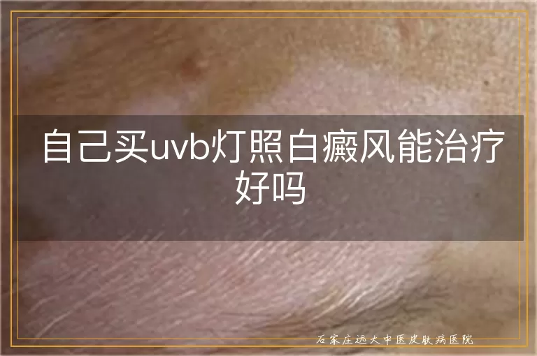 自己买uvb灯照白癜风能治疗好吗