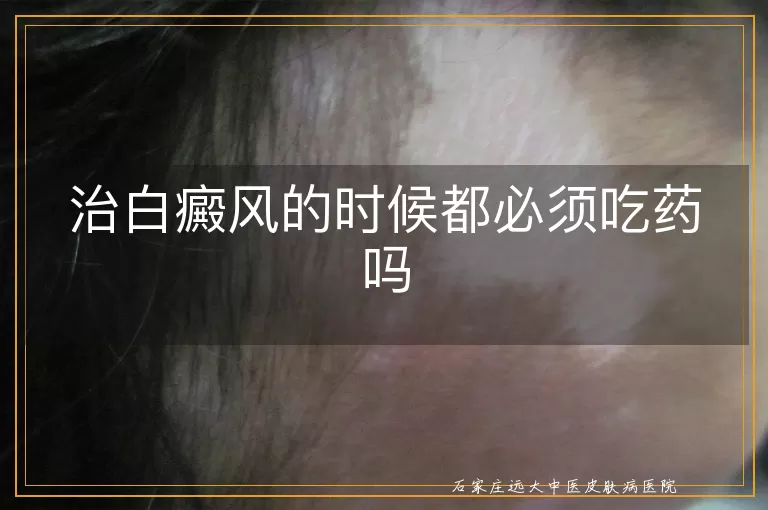 治白癜风的时候都必须吃药吗