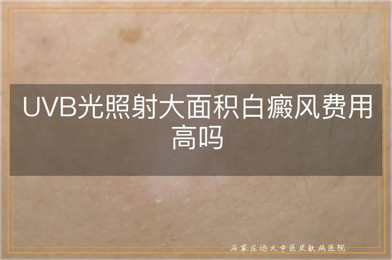 UVB光照射大面积白癜风费用高吗