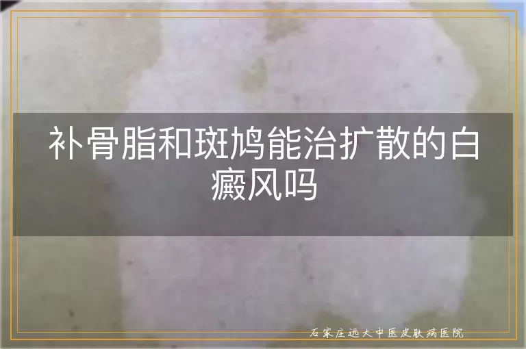 补骨脂和斑鸠能治扩散的白癜风吗