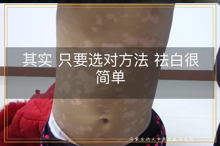其实 只要选对方法 祛白很简单