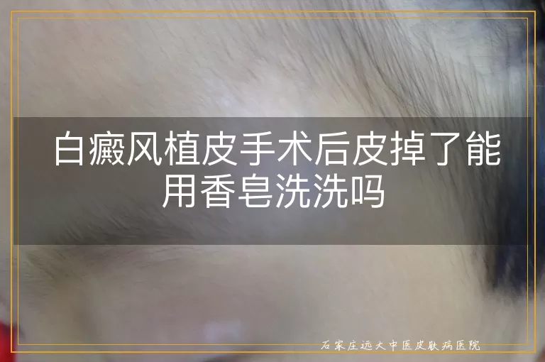 白癜风植皮手术后皮掉了能用香皂洗洗吗