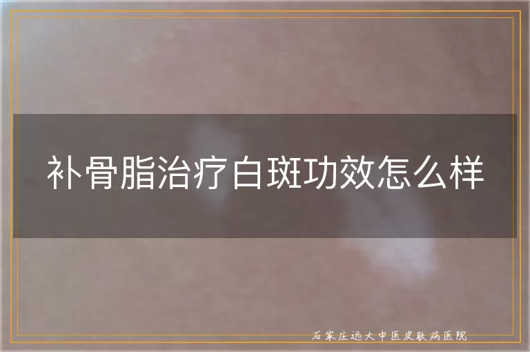 补骨脂治疗白斑功效怎么样