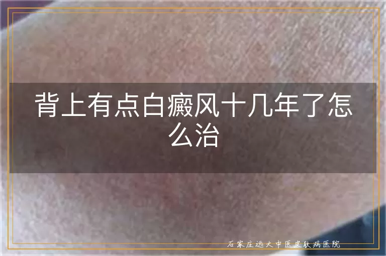背上有点白癜风十几年了怎么治