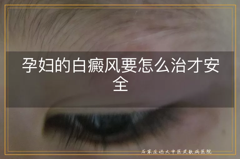 孕妇的白癜风要怎么治才安全