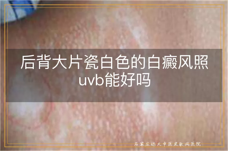 后背大片瓷白色的白癜风照uvb能好吗
