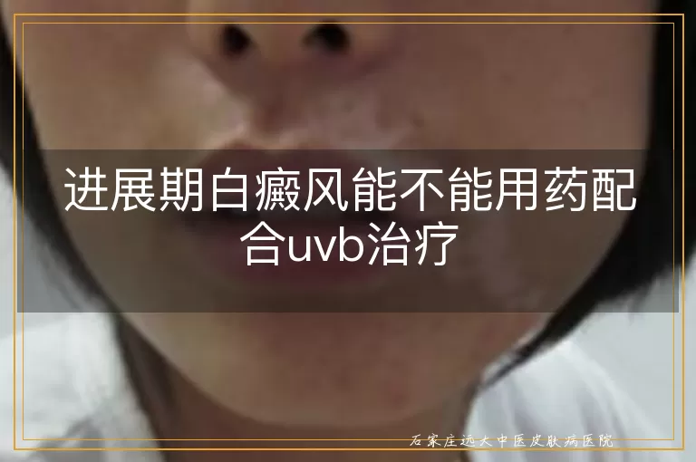 进展期白癜风能不能用药配合uvb治疗