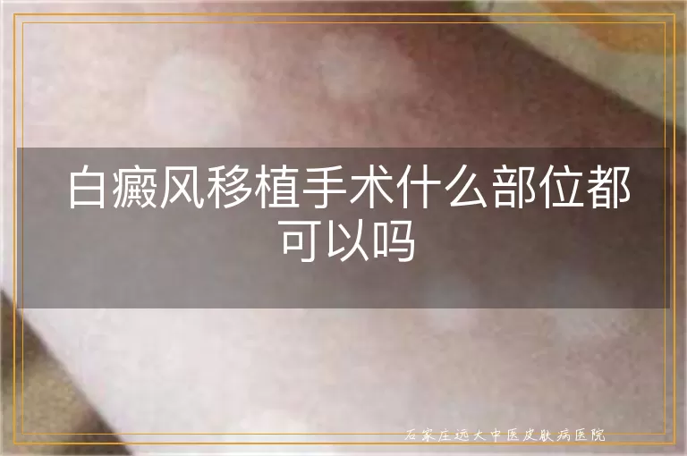 白癜风移植手术什么部位都可以吗