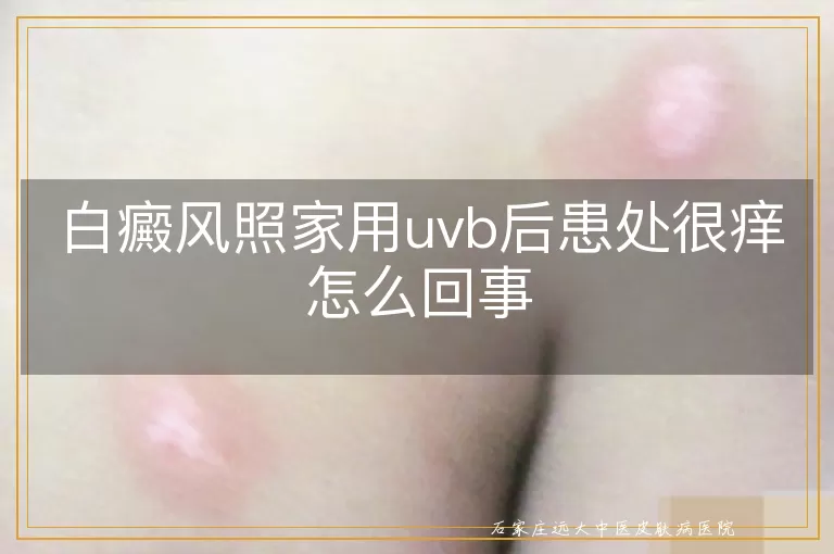 白癜风照家用uvb后患处很痒怎么回事