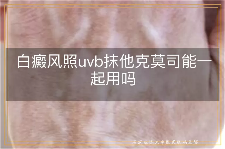 白癜风照uvb抹他克莫司能一起用吗