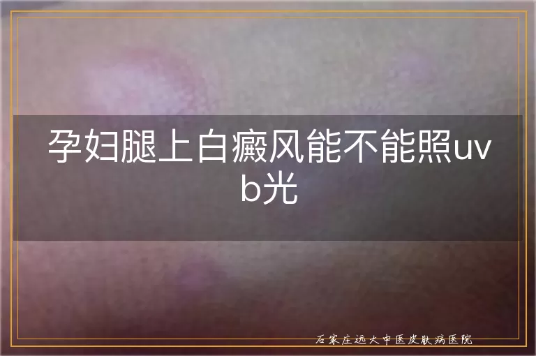 孕妇腿上白癜风能不能照uvb光