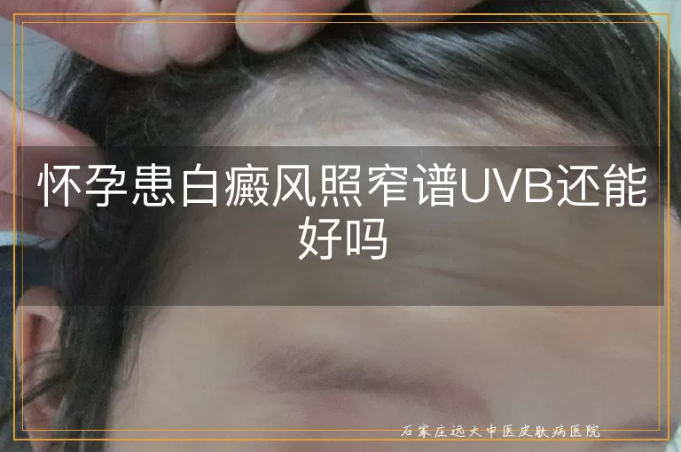 怀孕患白癜风照窄谱UVB还能好吗