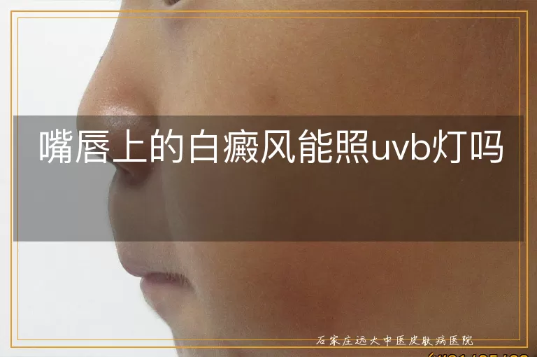 嘴唇上的白癜风能照uvb灯吗